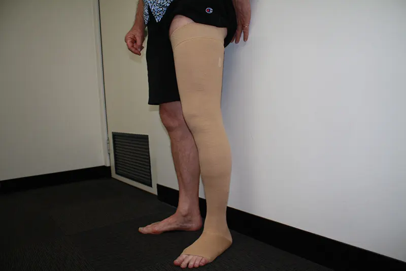 Patient wearing compression stocking on lower limb after lymphoedema treatment at Perth Lymphoedema Clinic
